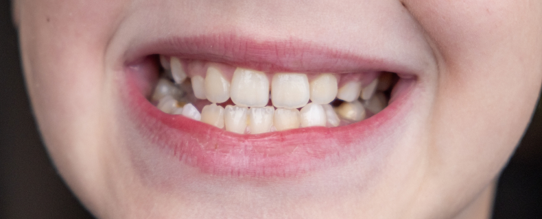 child teeth grinding